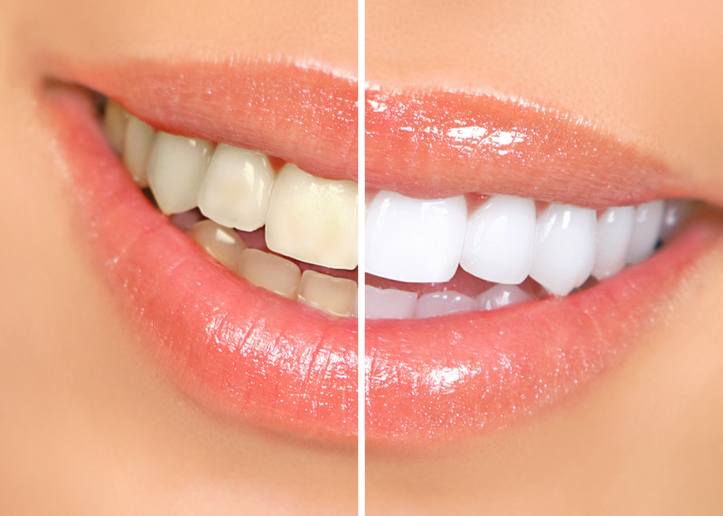 Teeth Whitening Tips